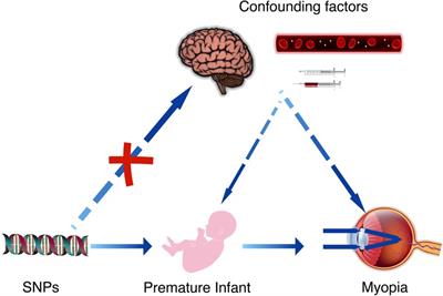 Mendelian randomization analysis reveals a causal relationship between preterm birth and myopia risk